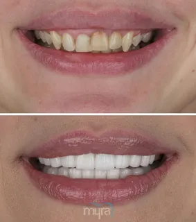 Crowns-turkey-narrow-smile-teeth-BL2-zirconium