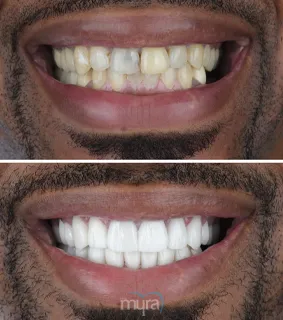 Dental-crowns-turkey-chipped-teeth-BL2-zirconium