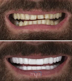 Dental-crowns-turkey-gummy-smile-BL2-zirconium