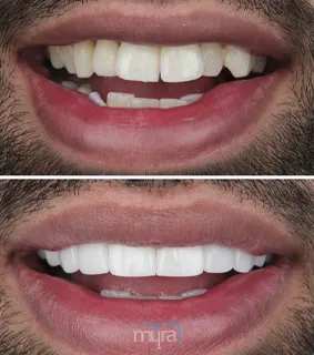 Dental-crowns-turkey-hollywood-smile-chipped-teeth-zirconium