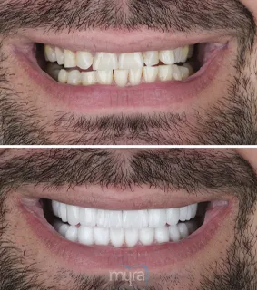 Dental-crowns-turkey-implant-smile-extraction-zirconium