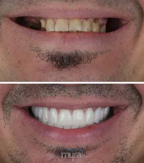 Dental-crowns-turkey-implant-teeth-zirconium