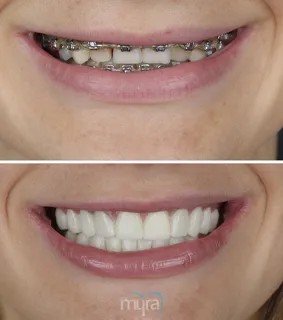 Dental-crowns-turkey-worn-chipped-teeth-zirconium
