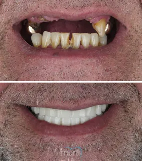 Dental-implants-gap-turkey-missing-teeth-zirconium