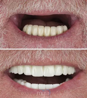 Dental-implants-turkey-bridge-missing-teeth-zirconium
