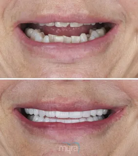 Dental-veneers-turkey-crooked-teeth-zirconium