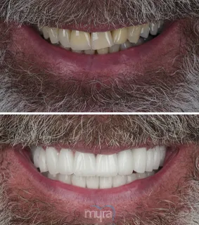 Dental-veneers-turkey-protruding-teeth-BL2-zirconium