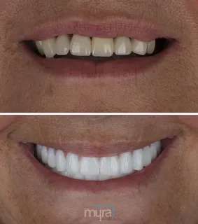 Full-mouth-dental-crowns-turkey-crooked-teeth-zirconium