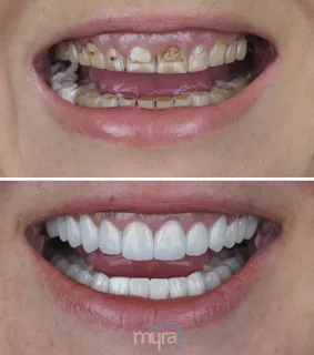 Full-set-of-Veneers-turkey-gaps-in-teeth-BL3-zirconium
