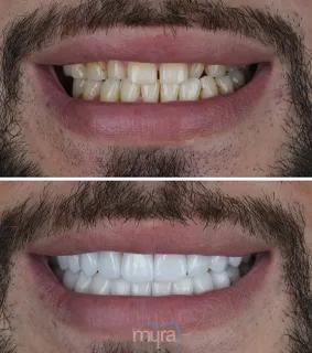 Full-set-of-veneers-turkey-discoloration-teeth-BL2-zirconium-