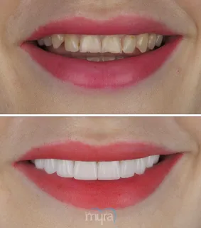 Full-set-of-veneers-turkey-grinded-uneven-teeth-emax