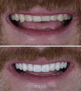 Full-set-of-veneers-turkey-grinded-uneven-teeth-BL3-zirconium