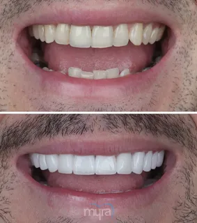 Full-set-of-veneers-turkey-grinded-uneven-teeth-zirconium