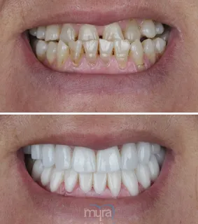 Full-set-of-veneers-under-bite-turkey-missing-teeth-zirconium