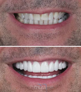 Full-veneers-turkey-gaps-in-teeth-zirconium
