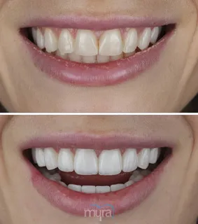 Laminate-Veneers-turkey-narrow-smile-emax