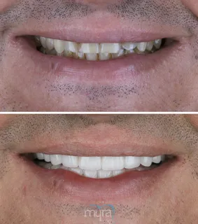 Full-mouth-crowns-turkey-chipped-discoloration-zirconium
