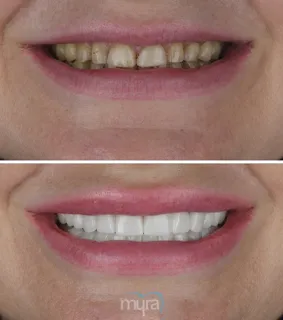 Full-crowns-turkey-smile-discoloration-zirconium