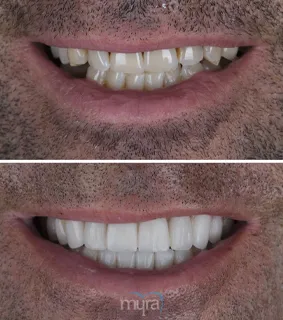 Laminate-veneers-turkey-stained-teeth-emax