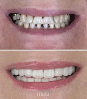 Partial-veneers-turkey-worn-teeth-zirconium