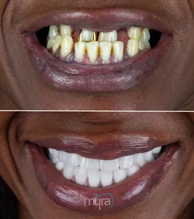 Teeth-crowns-turkey-full-mouth-implant-BL0-zirconium
