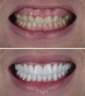 Teeth-crowns-turkey-worn-discoloration-teeth-zirconium-BL2