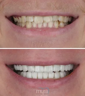 Teeth-partial-veneer-turkey-worn-missing-teeth-BL3-Emax