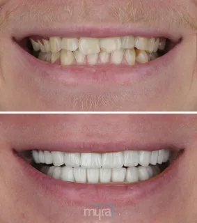 Teeth Turkey Pictures with partial veneers. He got 22 emax partial veneers with minimum preparation.