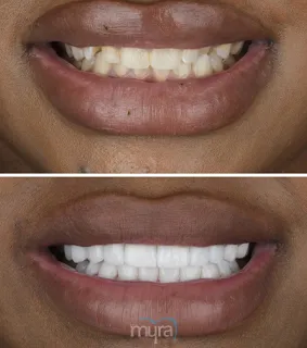 Veneers-turkey-crooked-teeth-smile-BL0-zirconium