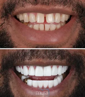 Veneers-turkey-missing-chipped-teeth-zirconium