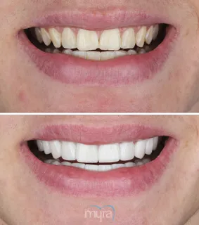 Veneers-turkey-missing-chipped-teeth-Celtra-BL2