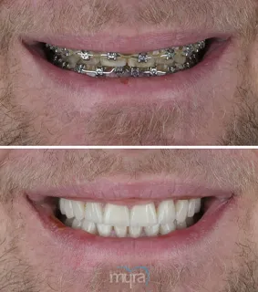 Veneers-turkey-missing-smile-implant-teeth-zirconium-emax