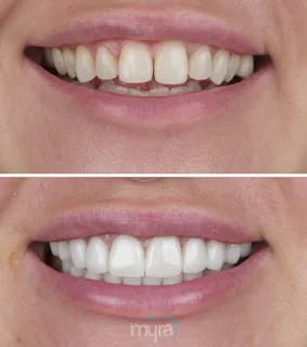 Veneers-turkey-missing-teeth-BL2-zirconium