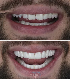 Veneers-turkey-missing-uneven-teeth-BL2-Celtra