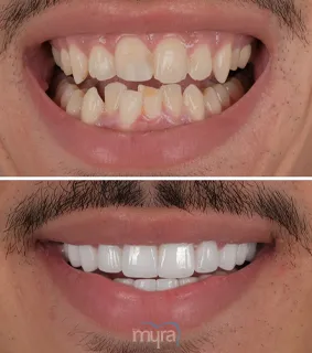 Veneers-turkey-narrow-cross-bite-smile-zirconium