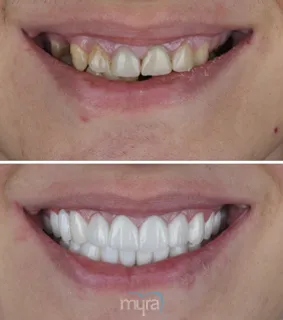 Veneers-turkey-narrow-smile-zirconium