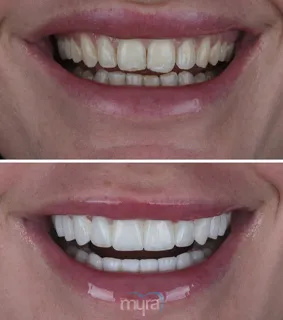 Veneers-turkey-open-bite-crooked-teeth-emax