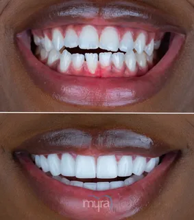 Veneers-turkey-open-bite-zirconium