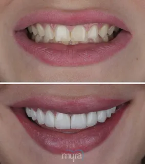 Veneers-turkey-uneven-teeth-emax