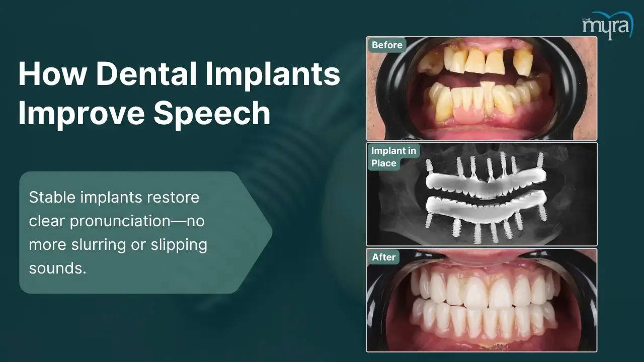 8-speech-impairments