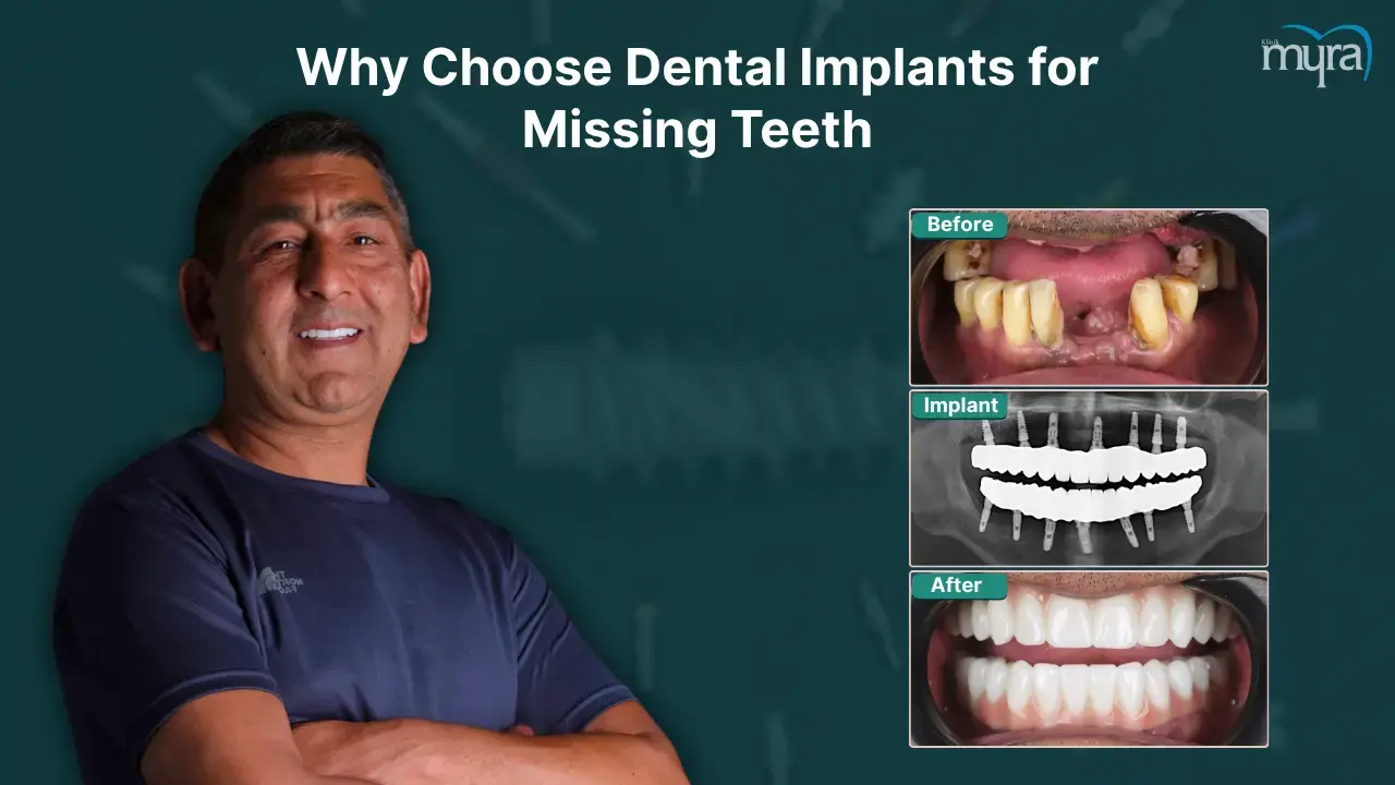 why-get-dental-implants