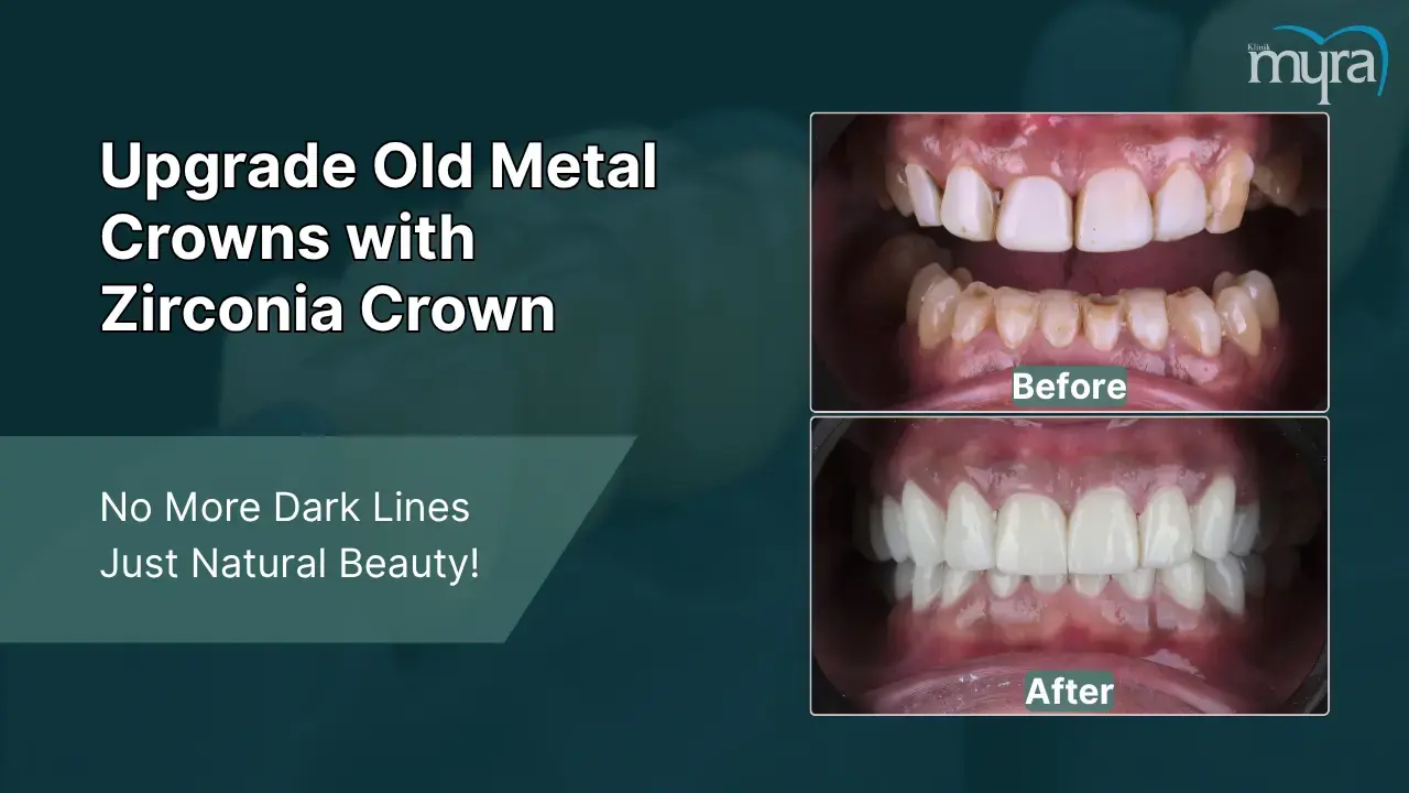 7-old-metal-crowns-or-fillings