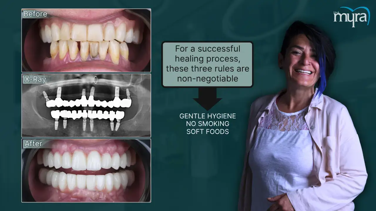 what-to-do-after-a-dental-implant-surgery