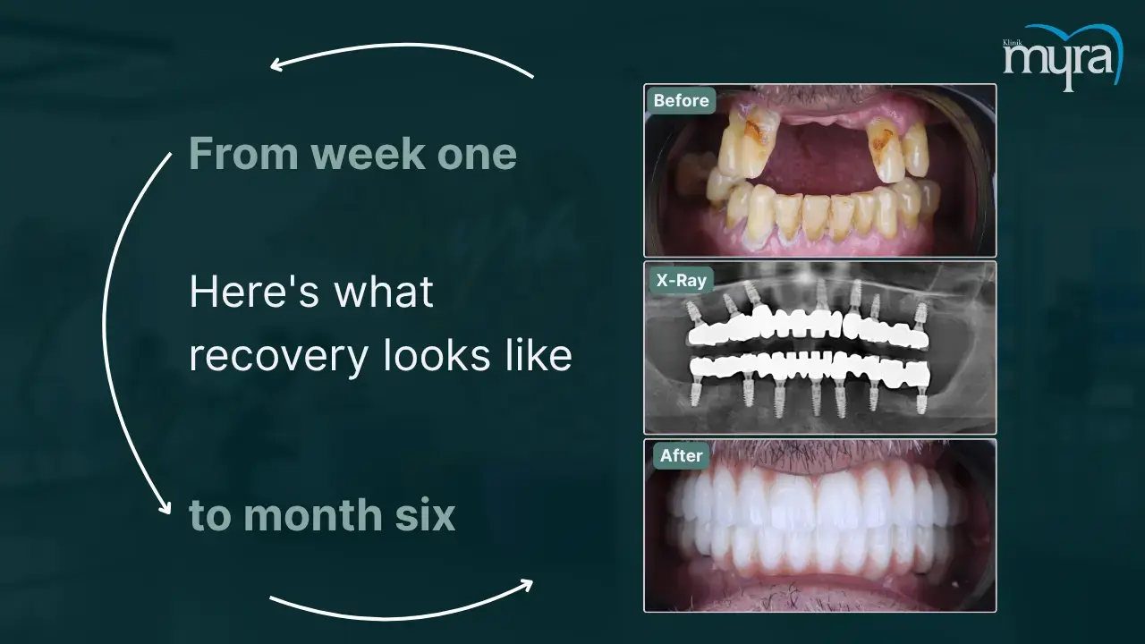 how-long-is-the-full-recovery-of-dental-implants