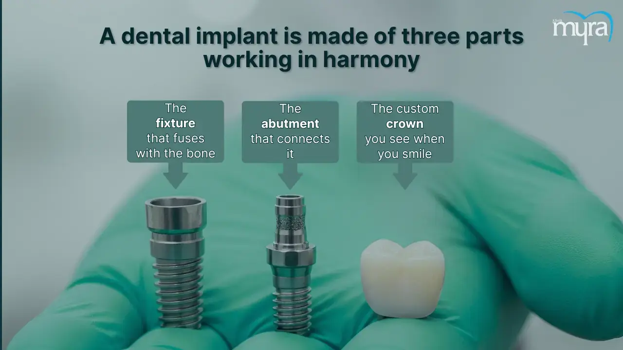 what-is-a-dental-implant