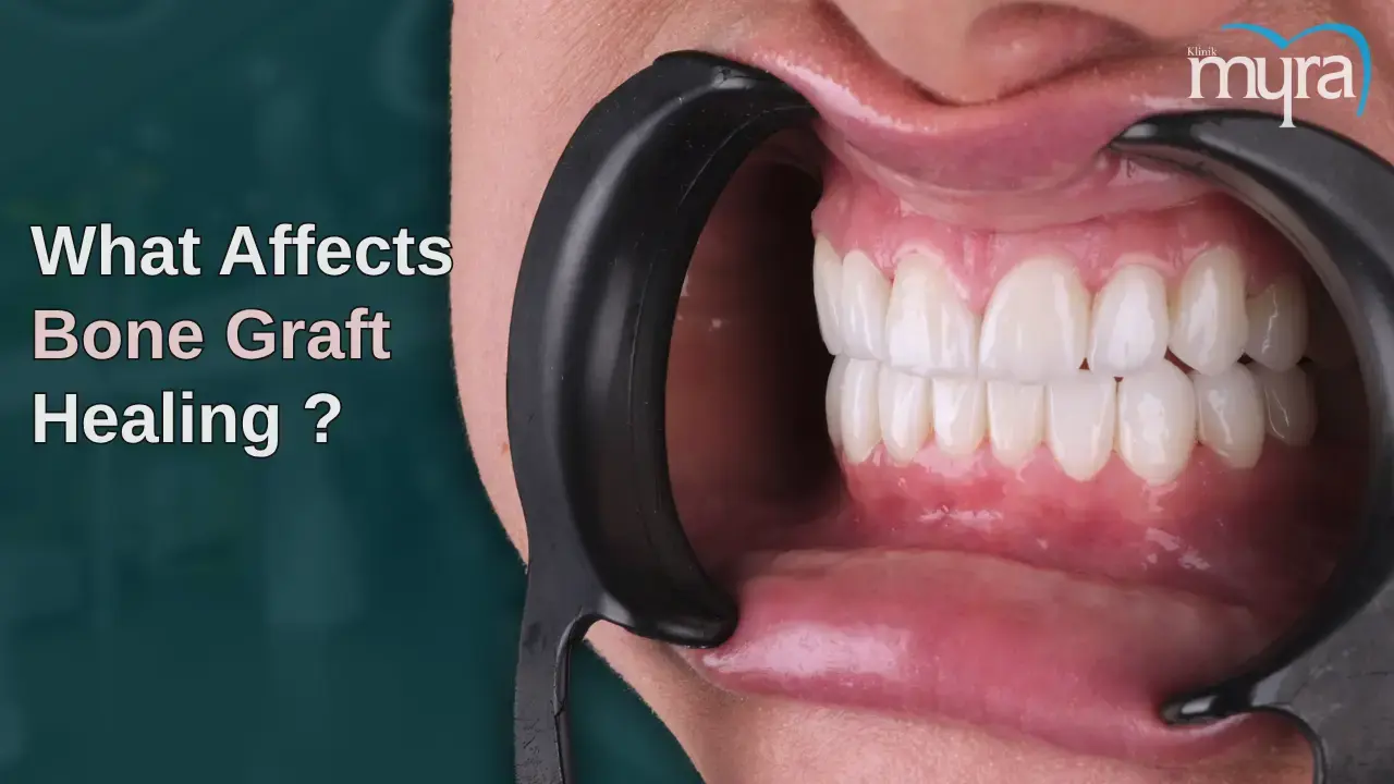 what-are-the-factors-affecting-the-healing-stages-of-dental-bone-grafts
