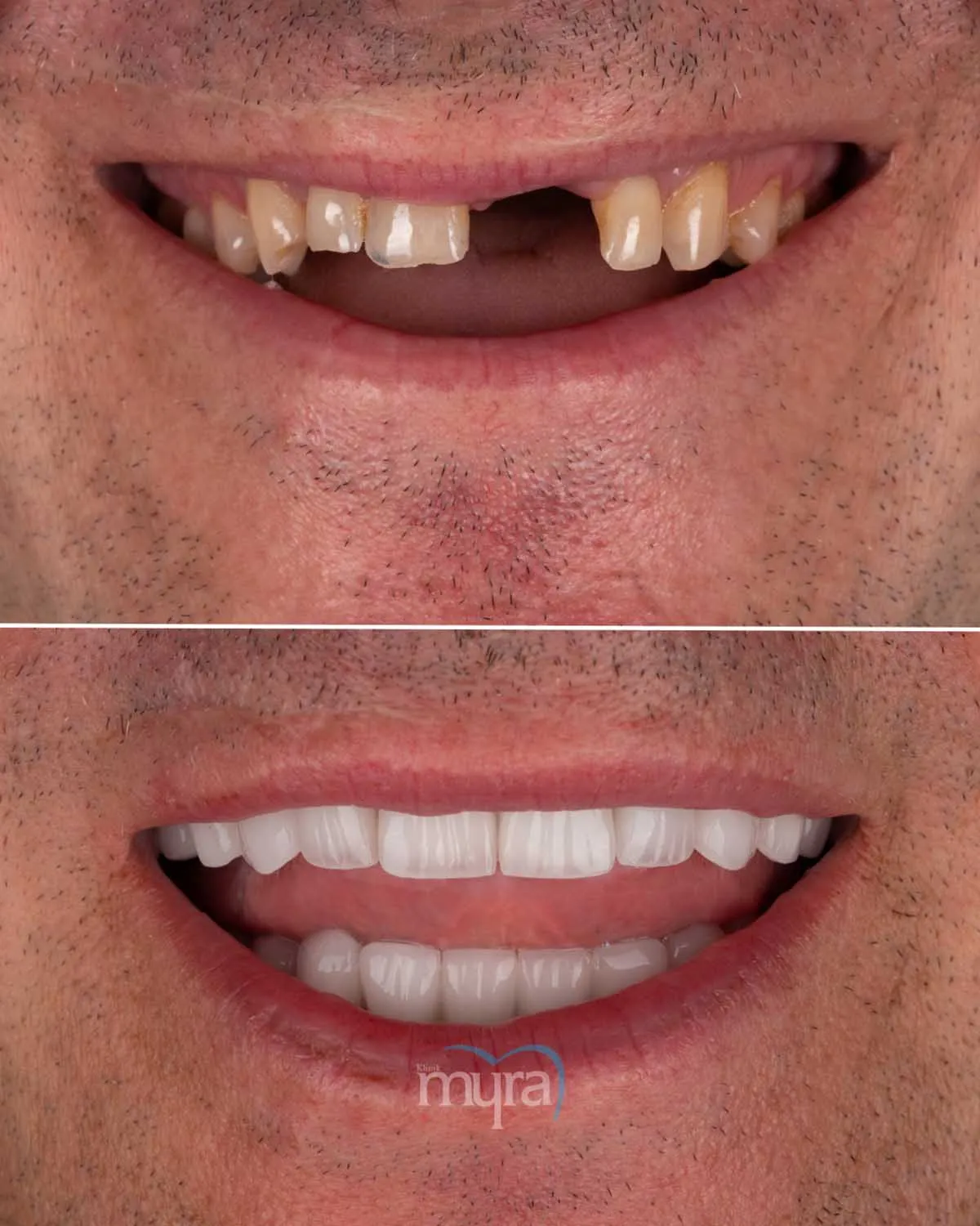 13-things-to-know-about-dental-implants-abroad-get-best-dental-implants,