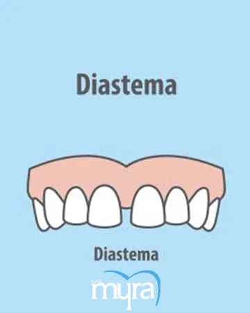 diastema-definition-types-causes-and-treatment