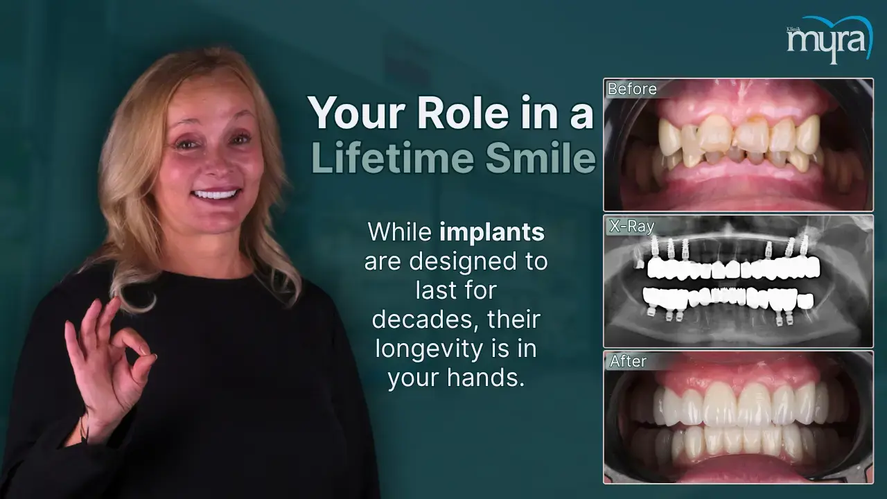how-long-does-a-dental-implant-last