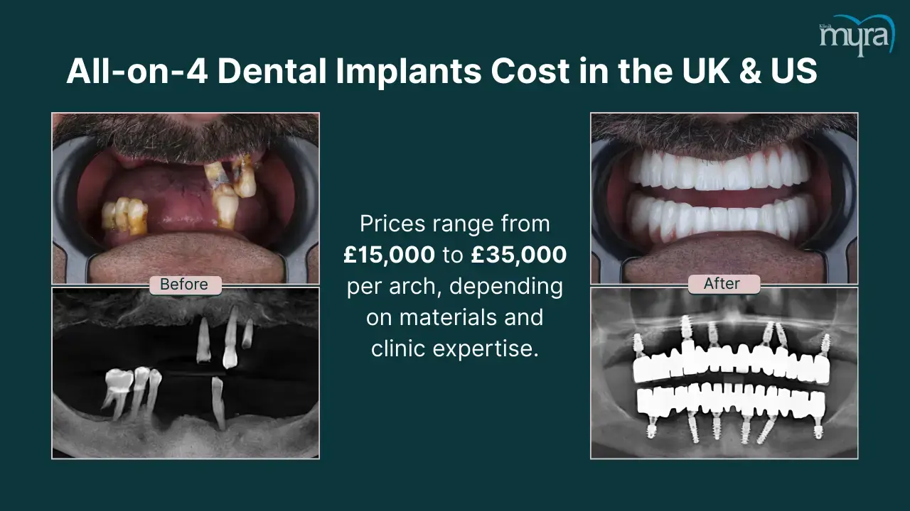 what-is-the-average-cost-for-all-on-4-dental-implants